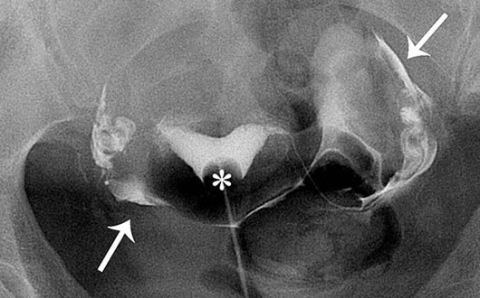 Histerosalpingografi (HSG)